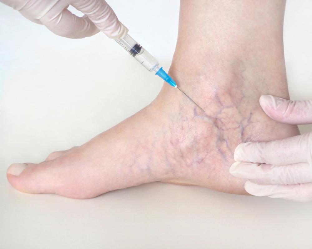 620eafe05e506204968f552c_Spider and Varicose Veins Treatments Sclerotherapy FAQs BIG