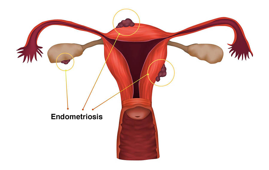 PA6G8X Endometriosis, illustration. A condition in which the endometrium, the layer of tissue that normally covers the inside of the uterus, grows outside of it.
