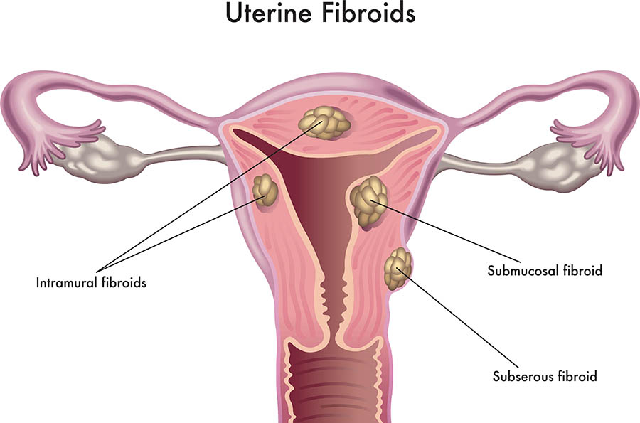 T6E1WE Medical illustration of the effects of the uterine fibroids