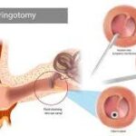 myrngotomy