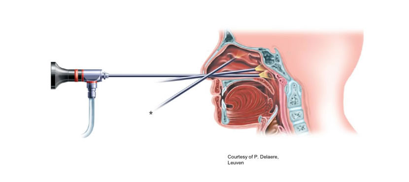 nasal-endoscopy