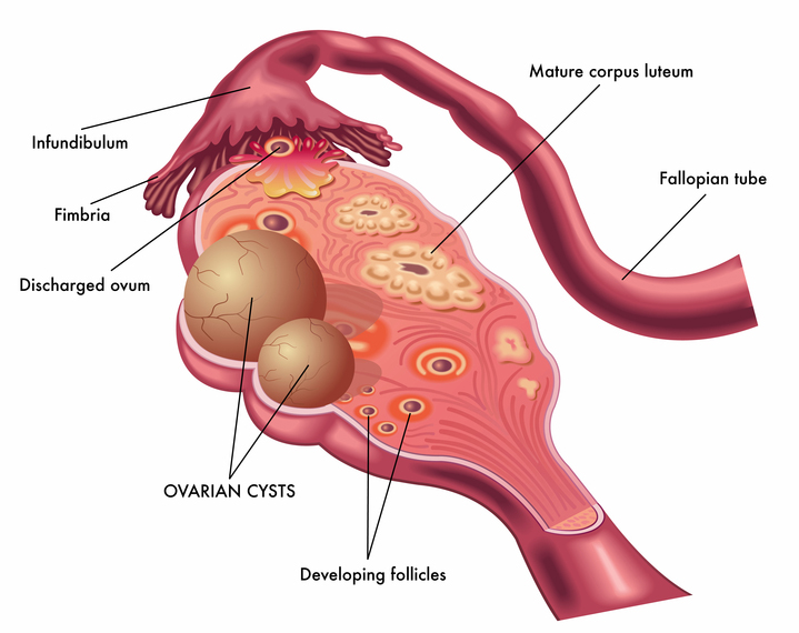 ovarian-cyst-symptoms
