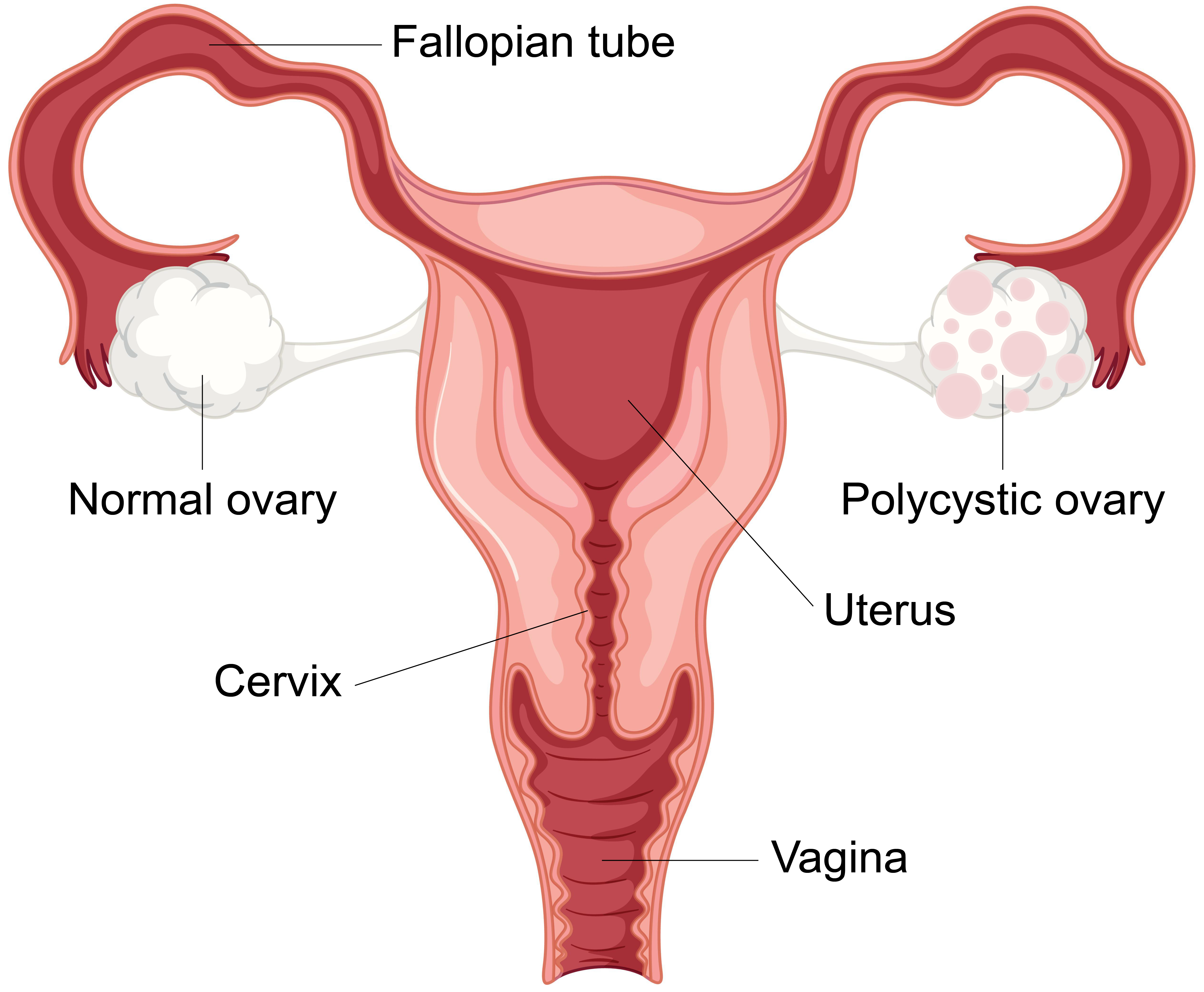 polycystic-ovarian-syndrome-pcos-a0470f