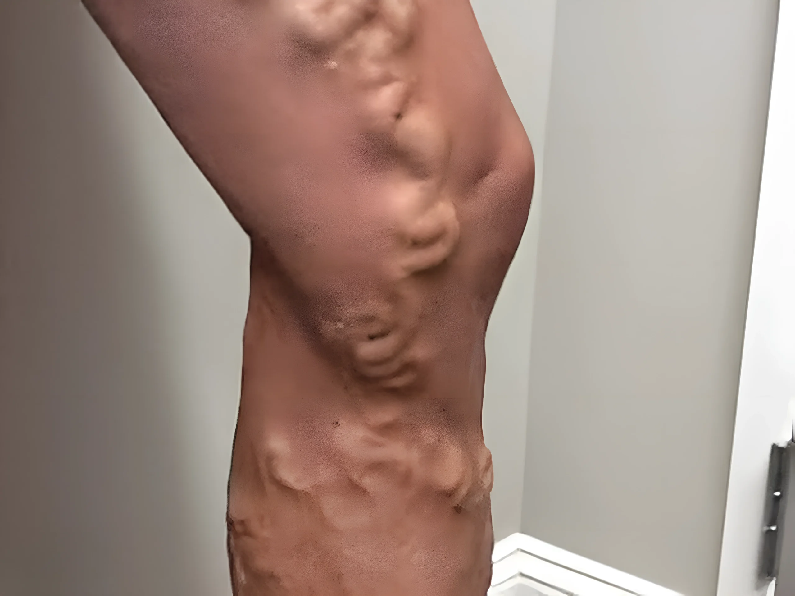 varicose vein